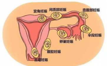 试管婴儿能避免遗传病吗？三代试管婴儿能避免遗传吗？