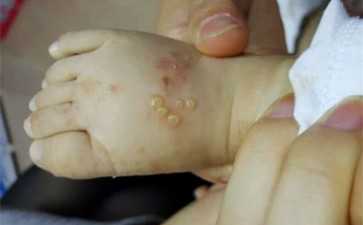 膝胸卧位纠正最佳时间 一天什么时间做膝胸卧位比较好--助孕机构费用价格